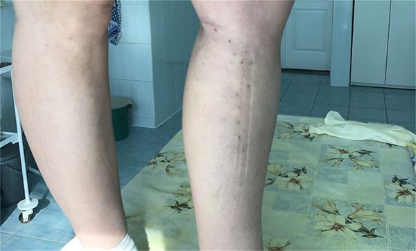 Ліва нога через 30 днів після радіочастотної абляції та мініфлебектомії